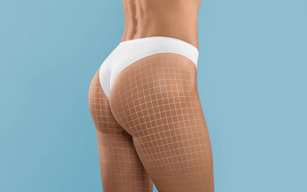 Contorno de glúteos: Você sabe como realçar suas curvas?