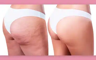 Sculptra corporal: Você sabia que pode transformar seu corpo?