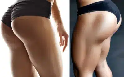 Preenchimento coxas: Você não vai acreditar no que pode fazer!