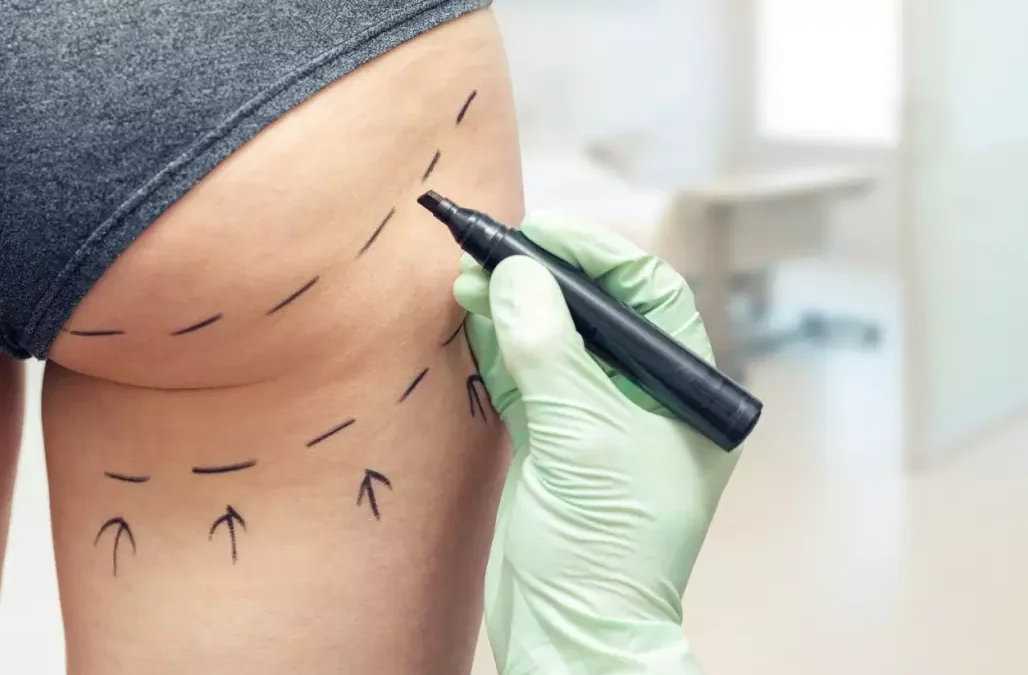 Lifting glúteo com fios: Você sabe o que é e como funciona?