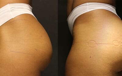 Preenchimento glúteo com gordura: Você sabia que isso pode transformar sua silhueta?