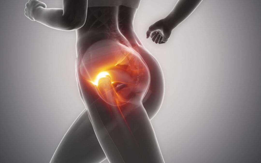 Depressão Trocanterica: O Que Ninguém Te Contou Sobre Ela